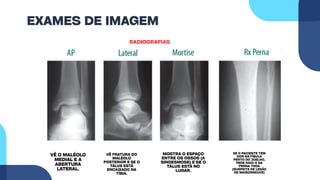 EXAMES DE IMAGEM
RADIOGRAFIAS
VÊ O MALÉOLO
MEDIAL E A
ABERTURA
LATERAL.
MOSTRA O ESPAÇO
ENTRE OS OSSOS (A
SINDESMOSE) E SE O
TÁLUS ESTÁ NO
LUGAR.
VÊ FRATURA DO
MALÉOLO
POSTERIOR E SE O
TÁLUS ESTÁ
ENCAIXADO NA
TÍBIA.
SE O PACIENTE TEM
DOR NA FÍBULA
PERTO DO JOELHO,
PEDE RAIO-X DA
PERNA TODA
(SUSPEITA DE LESÃO
DE MAISONNEUVE)
 