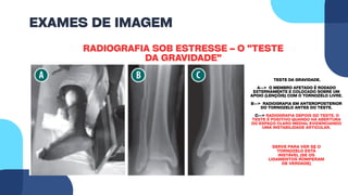 EXAMES DE IMAGEM
RADIOGRAFIA SOB ESTRESSE – O "TESTE
DA GRAVIDADE"
TESTE DA GRAVIDADE.
A--> O MEMBRO AFETADO É RODADO
EXTERNAMENTE E COLOCADO SOBRE UM
APOIO (LENÇÓIS) COM O TORNOZELO LIVRE.
B--> RADIOGRAFIA EM ANTEROPOSTERIOR
DO TORNOZELO ANTES DO TESTE.
C--> RADIOGRAFIA DEPOIS DO TESTE. O
TESTE É POSITIVO QUANDO HÁ ABERTURA
DO ESPAÇO CLARO MEDIAL EVIDENCIANDO
UMA INSTABILIDADE ARTICULAR.
SERVE PARA VER SE O
TORNOZELO ESTÁ
INSTÁVEL (SE OS
LIGAMENTOS ROMPERAM
DE VERDADE)
 