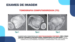 EXAMES DE IMAGEM
TOMOGRAFIA COMPUTADORIZADA (TC)
CLASSIFICAÇÃO TOMOGRÁFICA DAS FRATURAS DO MALÉOLO POSTERIOR. TIPO 1: TRAÇO
SIMPLES, FRAGMENTO POSTEROLATERAL. CORRESPONDE A 67% DOS CASOS. TIPO 2:
FRATURA COM EXTENSÃO MEDIAL. CORRESPONDE A 19% DOS CASOS. TIPO 3: FRATURA
COMINUTIVA OU DO REBORDO POSTERIOR. CORRESPONDE A 14% DOS CASOS.
 