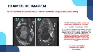 EXAMES DE IMAGEM
ULTRASSOM E RESSONÂNCIA – PARA LIGAMENTOS (CASOS ESPECIAIS)
RM DO TORNOZELO COM LESÃO DO
COMPLEXO LIGAMENTAR LATERAL.
A--> IMAGEM PONDERADA EM T1.
B--> IMAGEM PONDERADA EM T2. NESTES
CORTES VISUALIZAM-SE O TÁLUS NO SEU
MAIOR EIXO LONGITUDINAL E A FÍBULA EM
FORMATO DE “VÍRGULA”. AMBAS AS
IMAGENS EVIDENCIAM UMA ÁREA DE
TECIDO FIBROCICATRICIAL (SETAS
BRANCAS) QUE APONTA A LESÃO DO
LIGAMENTO TALOFIBULAR ANTERIOR
(LTFA).
SÃO MAIS PARA LESÕES
LIGAMENTARES PURAS
(ENTORSES).
 