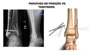 PARAFUSO DE POSIÇÃO VS.
TIGHTROPE:
 