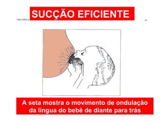 A seta mostra o movimento de ondulação da língua do bebê de diante para trás SUCÇÃO EFICIENTE 