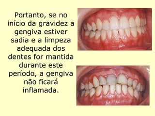 Portanto, se no início da gravidez a gengiva estiver sadia e a limpeza adequada dos dentes for mantida durante este período, a gengiva não ficará inflamada. 