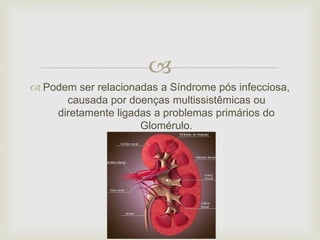  
 Podem ser relacionadas a Síndrome pós infecciosa, 
causada por doenças multissistêmicas ou 
diretamente ligadas a problemas primários do 
Glomérulo. 
 