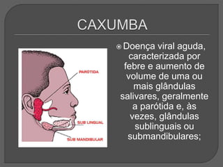  Doença viral aguda,
caracterizada por
febre e aumento de
volume de uma ou
mais glândulas
salivares, geralmente
a parótida e, às
vezes, glândulas
sublinguais ou
submandibulares;
 