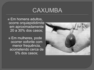  Em homens adultos,
ocorre orquiepididimite
em aproximadamente
20 a 30% dos casos;
 Em mulheres, pode
ocorrer ooforite com
menor frequência,
acometendo cerca de
5% dos casos;
 