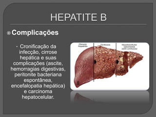 Complicações
• Cronificação da
infecção, cirrose
hepática e suas
complicações (ascite,
hemorragias digestivas,
peritonite bacteriana
espontânea,
encefalopatia hepática)
e carcinoma
hepatocelular.
 