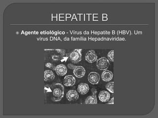  Agente etiológico - Vírus da Hepatite B (HBV). Um
vírus DNA, da família Hepadnaviridae.
 