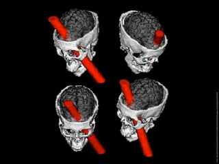 Image: http://psicocafe.blogosfere.it/2007/01/lincredibile-storia-di-phineas-gage-e-la-sua-sbarra-di-ferro.html
 