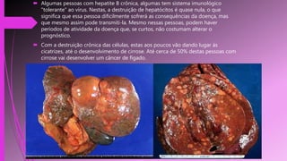  Algumas pessoas com hepatite B crônica, algumas tem sistema imunológico
"tolerante" ao vírus. Nestas, a destruição de hepatócitos é quase nula, o que
significa que essa pessoa dificilmente sofrerá as consequências da doença, mas
que mesmo assim pode transmiti-la. Mesmo nessas pessoas, podem haver
períodos de atividade da doença que, se curtos, não costumam alterar o
prognóstico.
 Com a destruição crônica das células, estas aos poucos vão dando lugar às
cicatrizes, até o desenvolvimento de cirrose. Até cerca de 50% destas pessoas com
cirrose vai desenvolver um câncer de fígado.
 