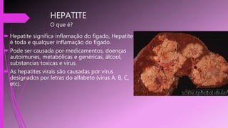 HEPATITE
O que é?
 Hepatite significa inflamação do fígado, Hepatite
é toda e qualquer inflamação do fígado.
 Pode ser causada por medicamentos, doenças
autoimunes, metabólicas e genéricas, álcool,
substancias toxicas e vírus.
 As hepatites virais são causadas por vírus
designados por letras do alfabeto (vírus A, B, C,
etc).
 