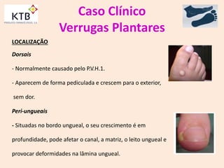 Caso Clínico
Verrugas Plantares
LOCALIZAÇÃO
Dorsais
- Normalmente causado pelo P.V.H.1.
- Aparecem de forma pediculada e crescem para o exterior,
sem dor.
Peri-ungueais
- Situadas no bordo ungueal, o seu crescimento é em
profundidade, pode afetar o canal, a matriz, o leito ungueal e
provocar deformidades na lâmina ungueal.
 