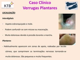 Caso Clínico
Verrugas Plantares
LOCALIZAÇÃO
Interdigitais
- Aspeto esbranquiçado e mole.
- Podem confundir-se com micose ou maceração.
- Muito dolorosas devido à pressão durante a marcha.
Plantares
- Habitualmente aparecem em zonas de apoio, rodeadas por tecido
córneo, que comprimem as terminações nervosas tornando-se
muito dolorosas. São pequenas e muito frequentes.
 