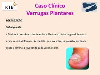 Caso Clínico
Verrugas Plantares
LOCALIZAÇÃO
Subungueais
- Devido à pressão existente entre a lâmina e o leito ungueal, tendem
a ser muito dolorosas. À medida que crescem, a pressão aumenta
sobre a lâmina, provocando cada vez mais dor.
 