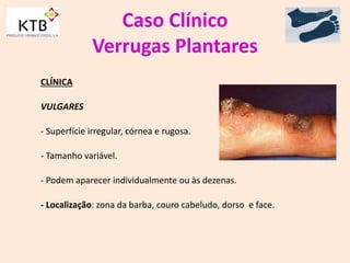 Caso Clínico
Verrugas Plantares
CLÍNICA
VULGARES
- Superfície irregular, córnea e rugosa.
- Tamanho variável.
- Podem aparecer individualmente ou às dezenas.
- Localização: zona da barba, couro cabeludo, dorso e face.
 