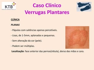 Caso Clínico
Verrugas Plantares
CLÍNICA
PLANAS
- Pápulas com saliências apenas percetíveis.
- Lisas, de 1-5mm, aplanadas e pequenas.
- Sem alteração da cor (pele).
- Podem ser múltiplas.
Localização: face anterior das pernas(rótula), dorso das mãos e cara.
 