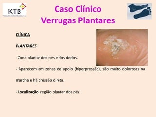 Caso Clínico
Verrugas Plantares
CLÍNICA
PLANTARES
- Zona plantar dos pés e dos dedos.
- Aparecem em zonas de apoio (hiperpressão), são muito dolorosas na
marcha e há pressão direta.
- Localização: região plantar dos pés.
 