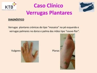 Caso Clínico
Verrugas Plantares
DIAGNÓSTICO
Verrugas plantares crónicas do tipo “mosaico” no pé esquerdo e
verrugas palmares no dorso e palma das mãos tipo “couve-flor”.
Vulgares Planas
 