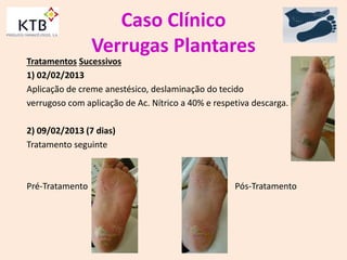 Caso Clínico
Verrugas Plantares
Tratamentos Sucessivos
1) 02/02/2013
Aplicação de creme anestésico, deslaminação do tecido
verrugoso com aplicação de Ac. Nítrico a 40% e respetiva descarga.
2) 09/02/2013 (7 dias)
Tratamento seguinte
Pré-Tratamento Pós-Tratamento
 