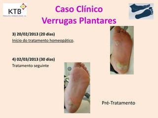 Caso Clínico
Verrugas Plantares
3) 20/02/2013 (20 dias)
Início do tratamento homeopático.
4) 02/03/2013 (30 dias)
Tratamento seguinte
Pré-Tratamento
 