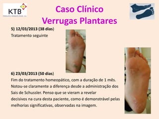 Caso Clínico
Verrugas Plantares
5) 12/03/2013 (38 dias)
Tratamento seguinte
6) 23/03/2013 (50 dias)
Fim do tratamento homeopático, com a duração de 1 mês.
Notou-se claramente a diferença desde a administração dos
Sais de Schussler. Penso que se vieram a revelar
decisivos na cura desta paciente, como é demonstrável pelas
melhorias significativas, observadas na imagem.
 