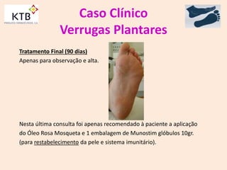 Caso Clínico
Verrugas Plantares
Tratamento Final (90 dias)
Apenas para observação e alta.
Nesta última consulta foi apenas recomendado à paciente a aplicação
do Óleo Rosa Mosqueta e 1 embalagem de Munostim glóbulos 10gr.
(para restabelecimento da pele e sistema imunitário).
 