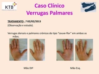 Caso Clínico
Verrugas Palmares
TRATAMENTO…? 02/02/2013
(Observação e estudo).
Verrugas dorsais e palmares crónicas do tipo “couve-flor” em ambas as
mãos.
Mão Dtª Mão Esq.
 