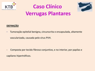 Caso Clínico
Verrugas Plantares
DEFINIÇÃO
- Tumoração epitelial benigna, circunscrita e encapsulada, altamente
vascularizada, causada pelo vírus PVH.
- Composta por tecido fibroso conjuntivo, e no interior, por papilas e
capilares hipertróficos.
 