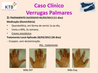 Caso Clínico
Verrugas Palmares
2) TRATAMENTO SUCESSIVO 02/03/2013 (11 dias)
Medicação (Domiciliária)
• Queratolítico, em forma de verniz 1x ao dia,
• Ureia a 40%, 2x semana,
• Creme anestésico.
Tratamento Local Aplicado 20/03/2012 (30 dias)
- Cryopen, sem deslaminação.
Pós - tratamento
Mão Dtª Mão Esq.
 