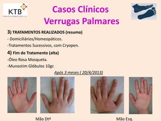 Casos Clínicos
Verrugas Palmares
3) TRATAMENTOS REALIZADOS (resumo)
- Domiciliários/Homeopáticos.
-Tratamentos Sucessivos, com Cryopen.
4) Fim do Tratamento (alta)
-Óleo Rosa Mosqueta.
-Munostim Glóbulos 10gr.
Após 3 meses ( 20/4/2013)
Mão Dtª Mão Esq.
 