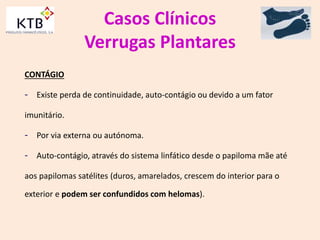 Casos Clínicos
Verrugas Plantares
CONTÁGIO
- Existe perda de continuidade, auto-contágio ou devido a um fator
imunitário.
- Por via externa ou autónoma.
- Auto-contágio, através do sistema linfático desde o papiloma mãe até
aos papilomas satélites (duros, amarelados, crescem do interior para o
exterior e podem ser confundidos com helomas).
 