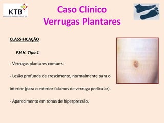 Caso Clínico
Verrugas Plantares
CLASSIFICAÇÃO
P.V.H. Tipo 1
- Verrugas plantares comuns.
- Lesão profunda de crescimento, normalmente para o
interior (para o exterior falamos de verruga pedicular).
- Aparecimento em zonas de hiperpressão.
 