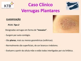 Caso Clínico
Verrugas Plantares
CLASSIFICAÇÃO
P.V.H. Tipo 2
Designadas verrugas em forma de “mosaico”.
- Surgem por auto-contágio.
- São planas, mais ou menos geométricas (esféricas).
- Normalmente são superficiais, de cor branca e indolores.
- Evoluem a partir da célula mãe e estão todas interligadas por via linfática.
 