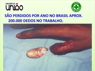 SÃO PERDIDOS POR ANO NO BRASIL APROX.
200.000 DEDOS NO TRABALHO.
 