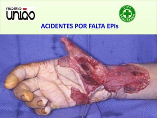 v
ACIDENTES POR FALTA EPIs
 