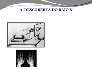 Colocando sua mão na trajetória dos raios X observou sobre a placa a sombra de seu esqueleto. Desta forma concluiu que os raios tinham a propriedade de penetrar e atravessar objetos opacos. Isto levou ao desenvolvimento da fotografia por meio de raios X, a radiografia. A  DESCOBERTA DO RAIO X 