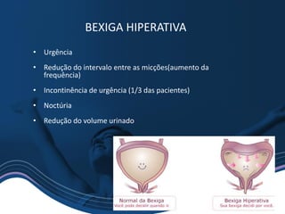 • Urgência
• Redução do intervalo entre as micções(aumento da
frequência)
• Incontinência de urgência (1/3 das pacientes)
• Noctúria
• Redução do volume urinado
BEXIGA HIPERATIVA
 