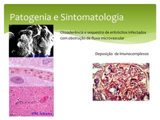 Patogenia e Sintomatologia
Citoaderência e sequestro de eritrócitos infectados
com obstrução de fluxo microvascular
Deposição de imunocomplexos
 