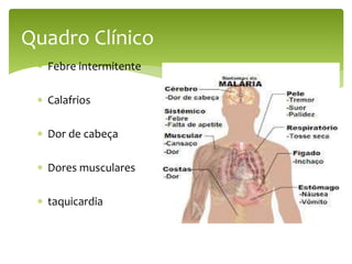  Febre intermitente
 Calafrios
 Dor de cabeça
 Dores musculares
 taquicardia
Quadro Clínico
 