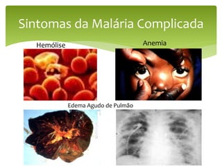 Hemólise
Sintomas da Malária Complicada
Anemia
Edema Agudo de Pulmão
 