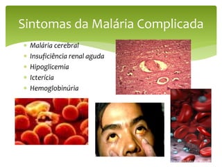  Malária cerebral
 Insuficiência renal aguda
 Hipoglicemia
 Icterícia
 Hemoglobinúria
Sintomas da Malária Complicada
 