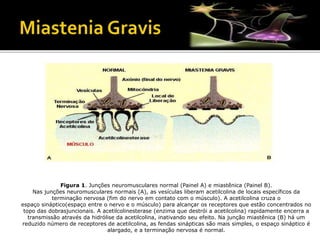 Figura 1. Junções neuromusculares normal (Painel A) e miastênica (Painel B).
Nas junções neuromusculares normais (A), as vesículas liberam acetilcolina de locais específicos da
terminação nervosa (fim do nervo em contato com o músculo). A acetilcolina cruza o
espaço sináptico(espaço entre o nervo e o músculo) para alcançar os receptores que estão concentrados no
topo das dobrasjuncionais. A acetilcolinesterase (enzima que destrói a acetilcolina) rapidamente encerra a
transmissão através da hidrólise da acetilcolina, inativando seu efeito. Na junção miastênica (B) há um
reduzido número de receptores de acetilcolina, as fendas sinápticas são mais simples, o espaço sináptico é
alargado, e a terminação nervosa é normal.
 