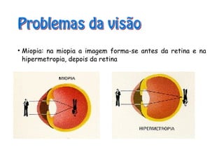 • Miopia: na miopia a imagem forma-se antes da retina e na
hipermetropia, depois da retina
 