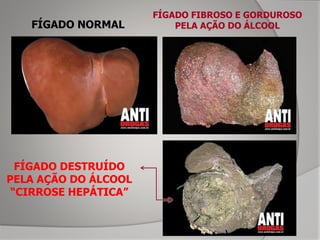 FÍGADO NORMAL
FÍGADO FIBROSO E GORDUROSO
PELA AÇÃO DO ÁLCOOL
FÍGADO DESTRUÍDO
PELA AÇÃO DO ÁLCOOL
“CIRROSE HEPÁTICA”
 