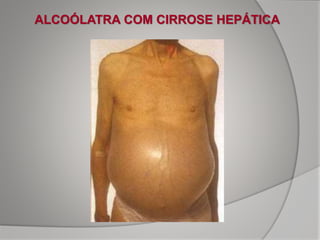 ALCOÓLATRA COM CIRROSE HEPÁTICA
 