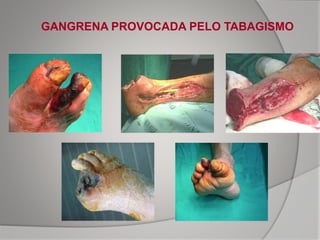 GANGRENA PROVOCADA PELO TABAGISMO
 