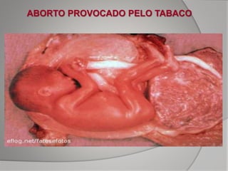 ABORTO PROVOCADO PELO TABACO
 