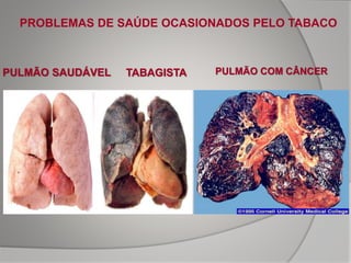 PULMÃO SAUDÁVEL PULMÃO COM CÂNCERTABAGISTA
PROBLEMAS DE SAÚDE OCASIONADOS PELO TABACO
 