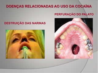 PERFURAÇÃO DO PALATO
DESTRUIÇÃO DAS NARINAS
DOENÇAS RELACIONADAS AO USO DA COCAÍNA
 