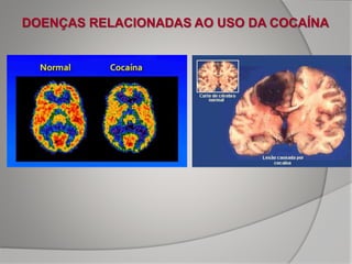 DOENÇAS RELACIONADAS AO USO DA COCAÍNA
 